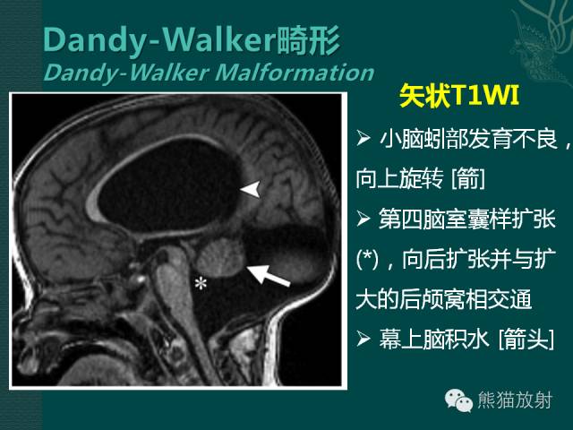 【专题】后颅窝先天性畸形