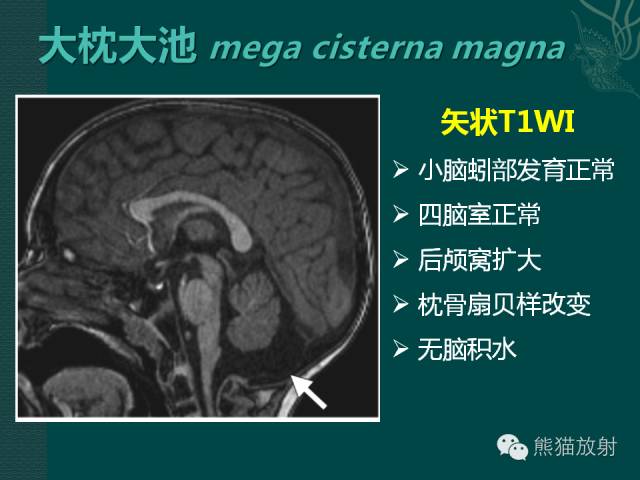 【专题】后颅窝先天性畸形
