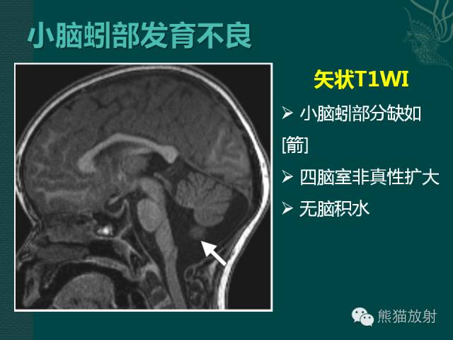 【专题】后颅窝先天性畸形