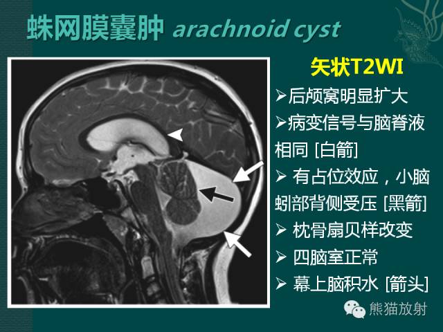 【专题】后颅窝先天性畸形