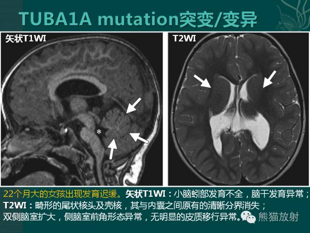 【专题】后颅窝先天性畸形