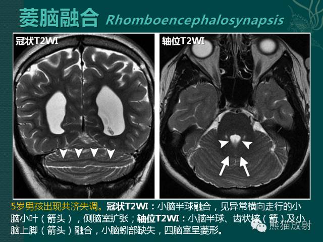 【专题】后颅窝先天性畸形