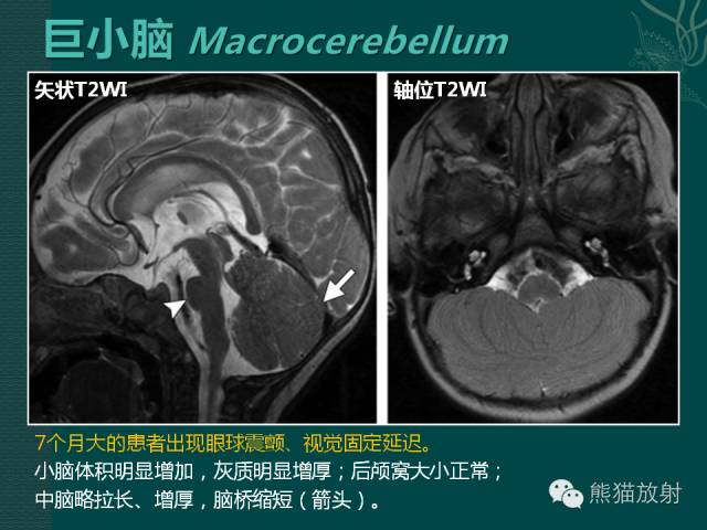 【专题】后颅窝先天性畸形