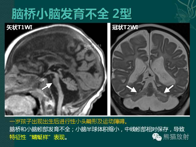 【专题】后颅窝先天性畸形