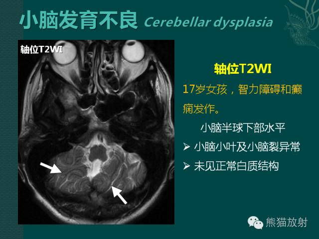 【专题】后颅窝先天性畸形