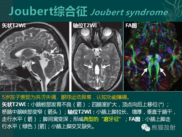 【专题】后颅窝先天性畸形