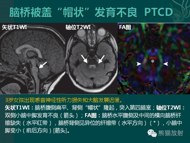 【专题】后颅窝先天性畸形