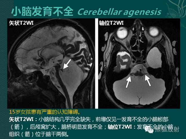 【专题】后颅窝先天性畸形
