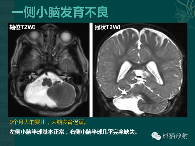 【专题】后颅窝先天性畸形