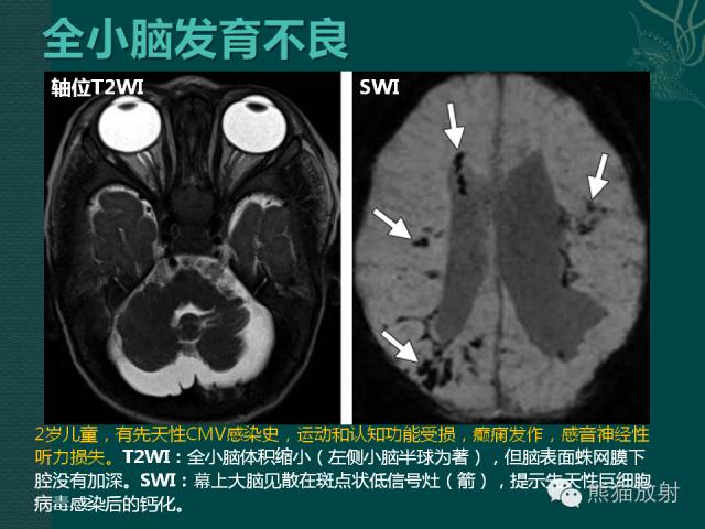 【专题】后颅窝先天性畸形