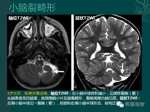 【专题】后颅窝先天性畸形