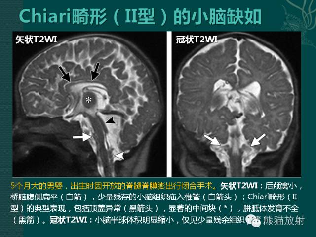 【专题】后颅窝先天性畸形