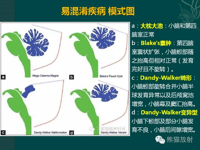 【专题】后颅窝先天性畸形