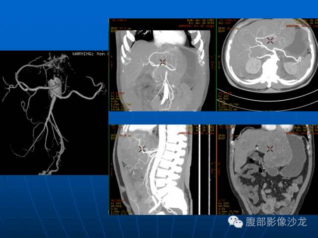 【病例】胃肠道间质瘤伴肝脏转移1例 【病例】胃肠道间质瘤伴肝脏转移1例