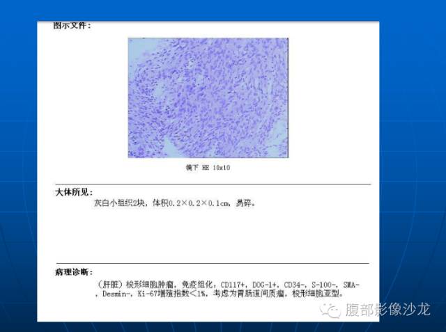 【病例】胃肠道间质瘤伴肝脏转移1例 【病例】胃肠道间质瘤伴肝脏转移1例