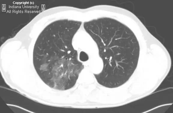 【病例】动静脉畸形继发肺出血