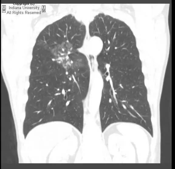 【病例】动静脉畸形继发肺出血 【病例】动静脉畸形继发肺出血