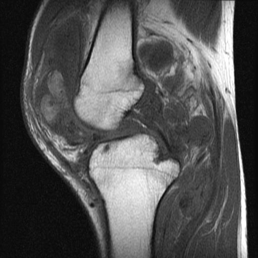 【病例】膝关节色素沉着绒毛结节性滑膜炎1例MR影像表现 【病例】膝关节色素沉着绒毛结节性滑膜炎1例MR影像表现