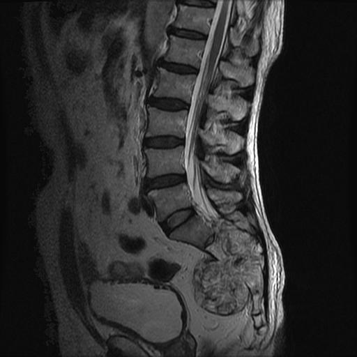 【病例】骶骨脊索瘤1例MR影像表现 【病例】骶骨脊索瘤1例MR影像表现