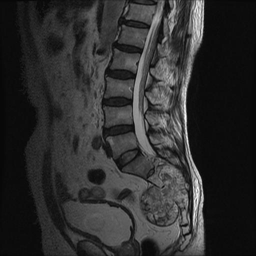 【病例】骶骨脊索瘤1例MR影像表现 【病例】骶骨脊索瘤1例MR影像表现