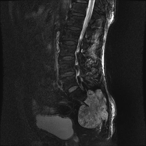 【病例】骶骨脊索瘤1例MR影像表现 【病例】骶骨脊索瘤1例MR影像表现