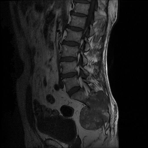 【病例】骶骨脊索瘤1例MR影像表现 【病例】骶骨脊索瘤1例MR影像表现