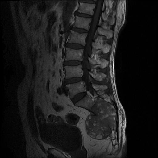 【病例】骶骨脊索瘤1例MR影像表现 【病例】骶骨脊索瘤1例MR影像表现