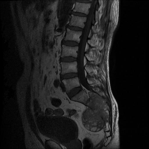 【病例】骶骨脊索瘤1例MR影像表现 【病例】骶骨脊索瘤1例MR影像表现