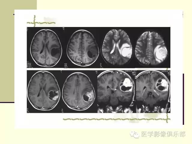【病例】脑室外室管膜瘤1例MR诊断与鉴别诊断