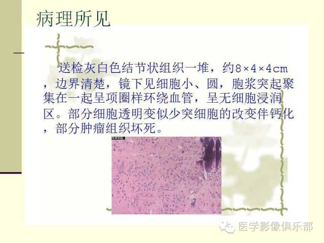 【病例】脑室外室管膜瘤1例MR诊断与鉴别诊断