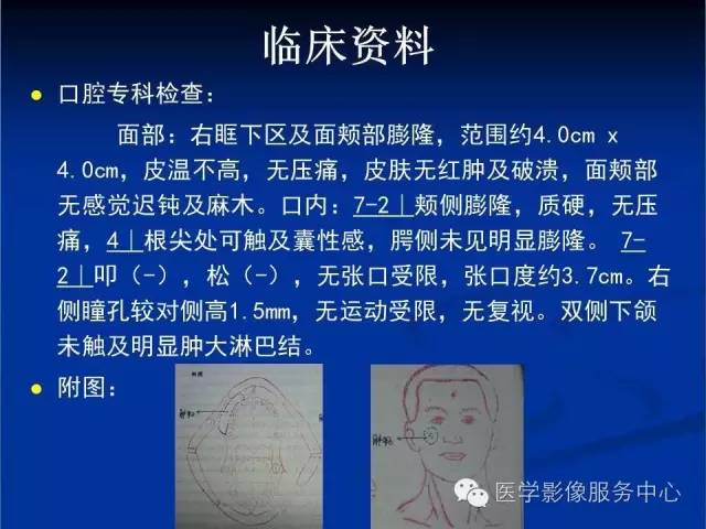 【病例】右侧上颌窦粘液瘤1例CT及MR影像表现