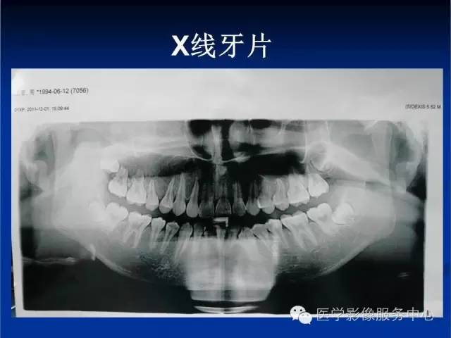 【病例】右侧上颌窦粘液瘤1例CT及MR影像表现