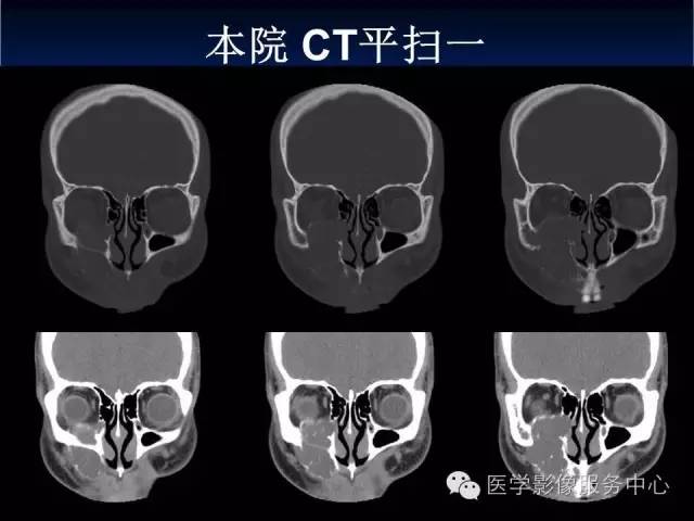 【病例】右侧上颌窦粘液瘤1例CT及MR影像表现