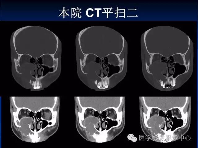 【病例】右侧上颌窦粘液瘤1例CT及MR影像表现