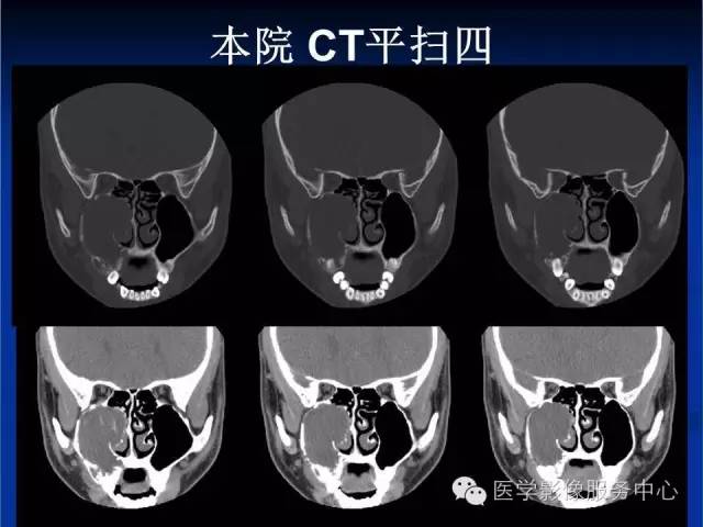 【病例】右侧上颌窦粘液瘤1例CT及MR影像表现