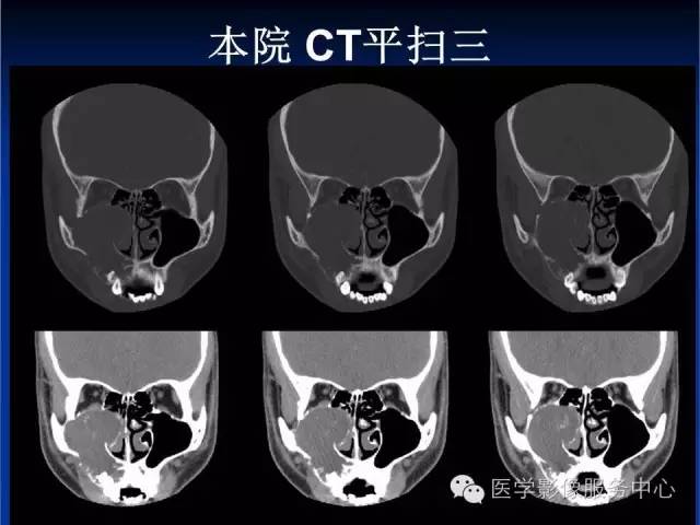 【病例】右侧上颌窦粘液瘤1例CT及MR影像表现