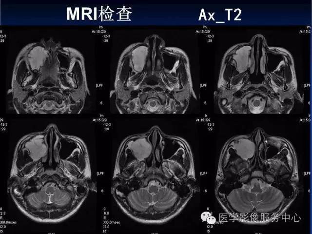 【病例】右侧上颌窦粘液瘤1例CT及MR影像表现