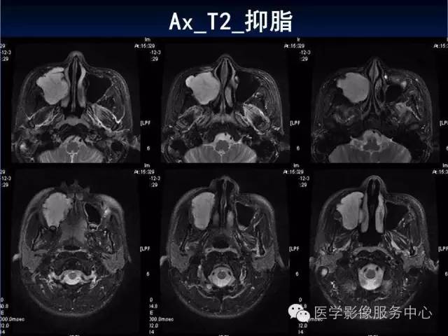 【病例】右侧上颌窦粘液瘤1例CT及MR影像表现