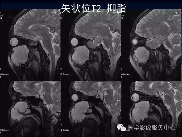 【病例】右侧上颌窦粘液瘤1例CT及MR影像表现
