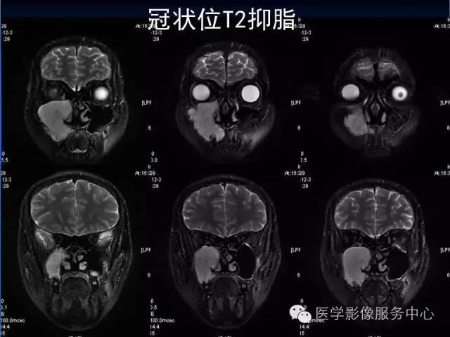 【病例】右侧上颌窦粘液瘤1例CT及MR影像表现