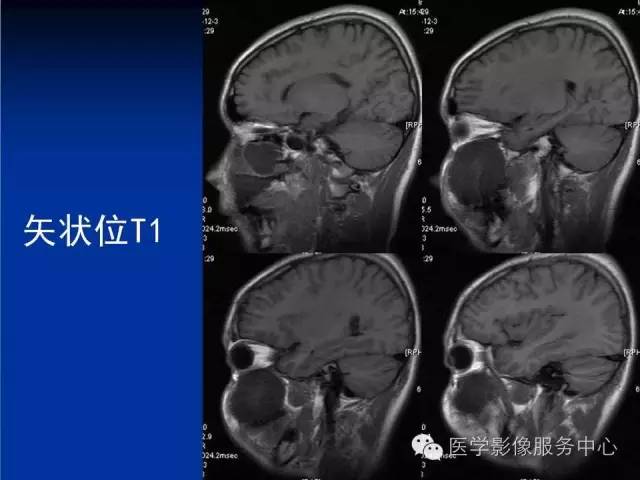 【病例】右侧上颌窦粘液瘤1例CT及MR影像表现