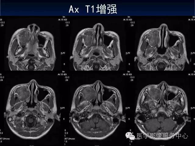 【病例】右侧上颌窦粘液瘤1例CT及MR影像表现