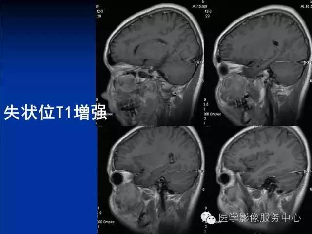 【病例】右侧上颌窦粘液瘤1例CT及MR影像表现