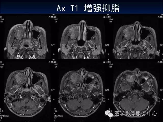 【病例】右侧上颌窦粘液瘤1例CT及MR影像表现