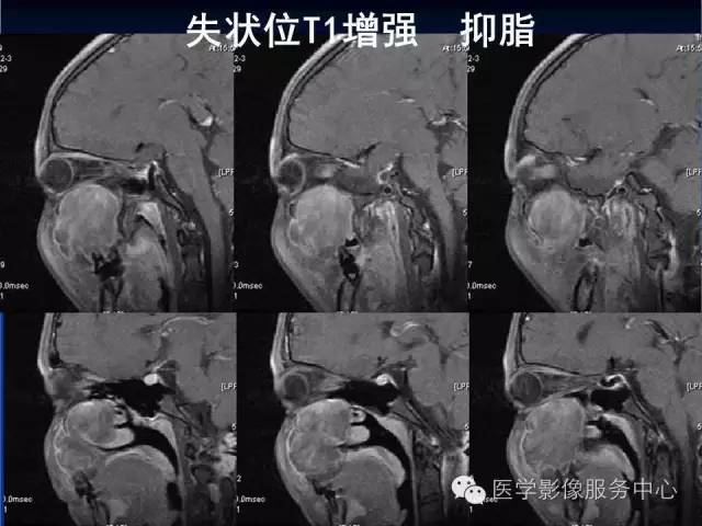 【病例】右侧上颌窦粘液瘤1例CT及MR影像表现