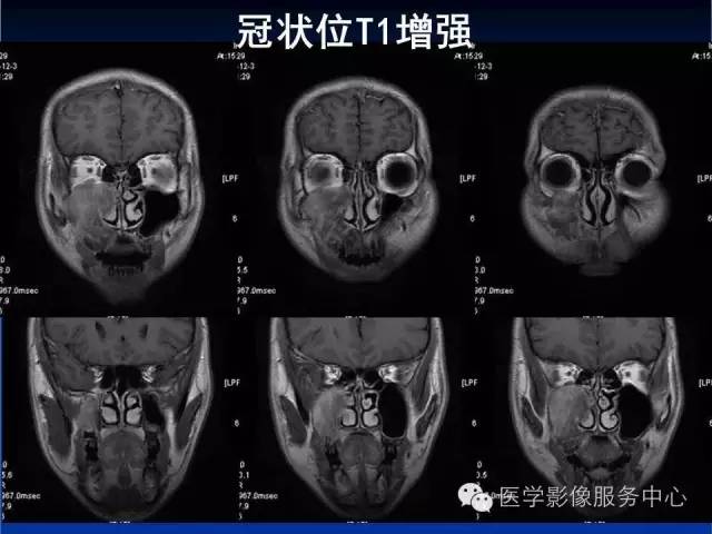 【病例】右侧上颌窦粘液瘤1例CT及MR影像表现