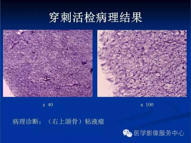 【病例】右侧上颌窦粘液瘤1例CT及MR影像表现