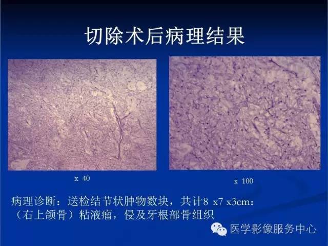 【病例】右侧上颌窦粘液瘤1例CT及MR影像表现