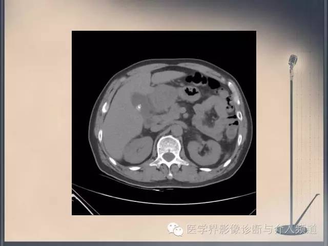 【病例】你以为这是肿瘤，其实这是鱼刺引发的“血案”！