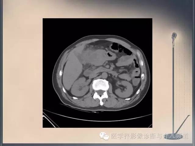 【病例】你以为这是肿瘤，其实这是鱼刺引发的“血案”！